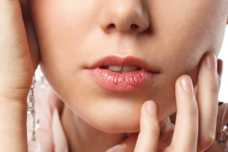 Handy year-round tips for dry skin and chapped lips