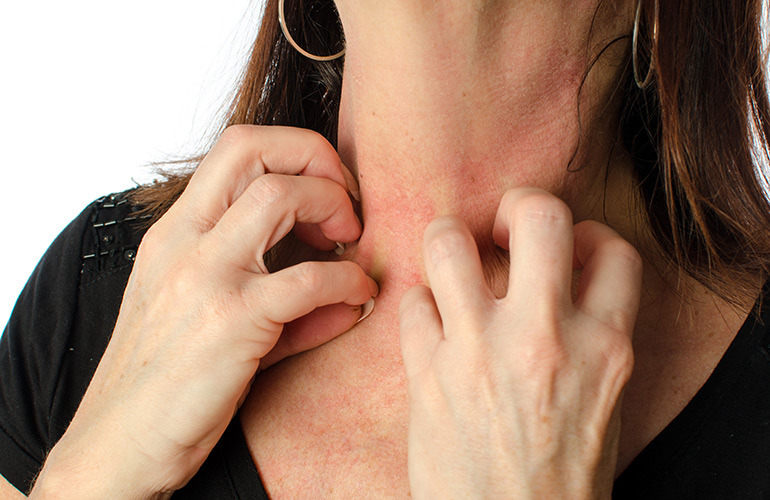 Eczema: the facts
