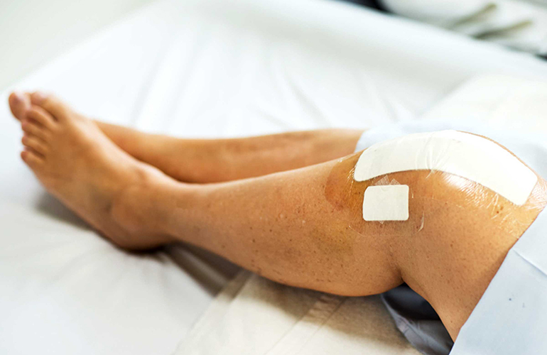 What is knee replacement?