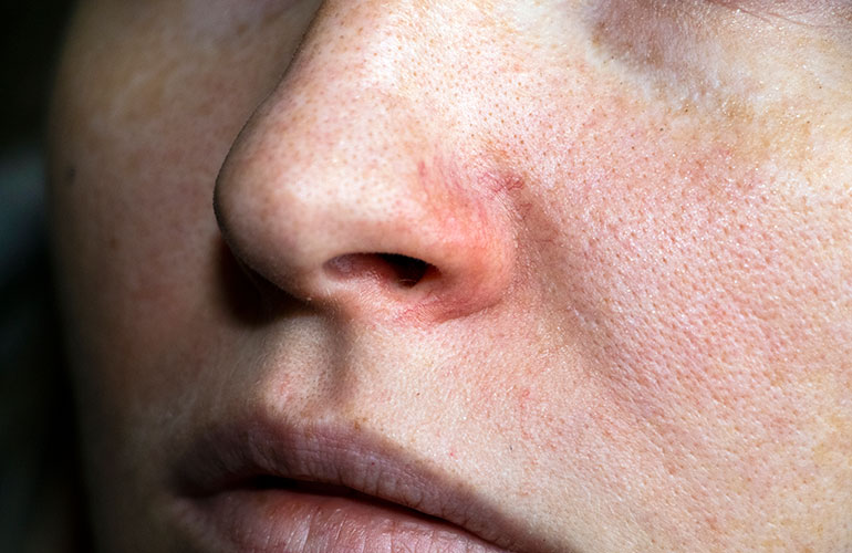 Extinguishing the redness