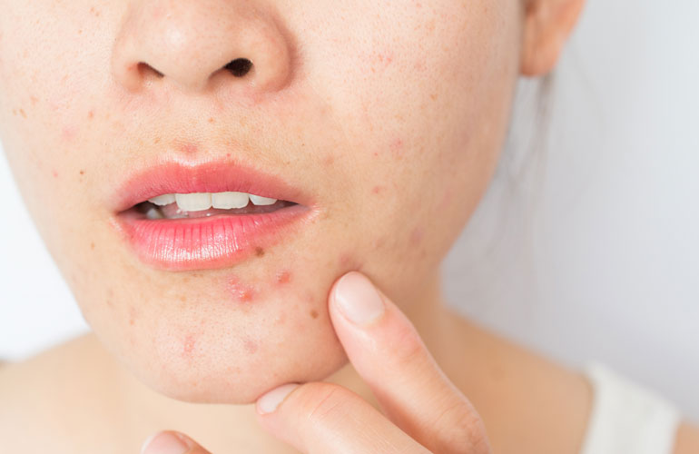 7 innocent habits that almost guarantee acne scars | Reader's Digest Asia